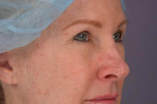 Eyelid Surgery Before & After Image