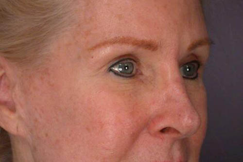 Eyelid Surgery Before & After Image