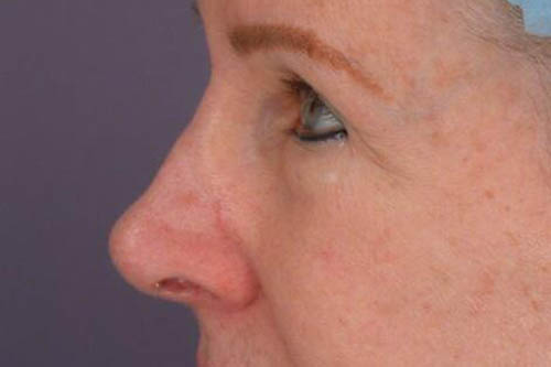 Eyelid Surgery Before & After Image