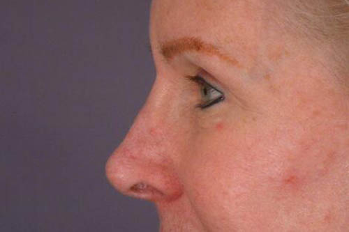 Eyelid Surgery Before & After Image