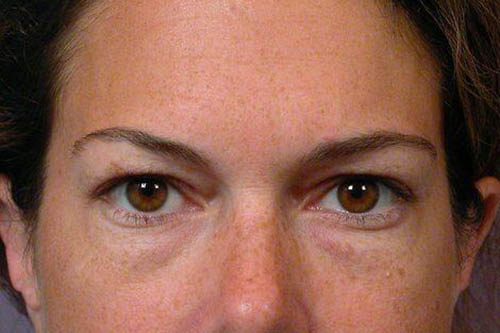 Eyelid Surgery Before & After Image