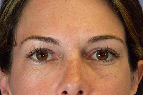 Eyelid Surgery Before & After Image