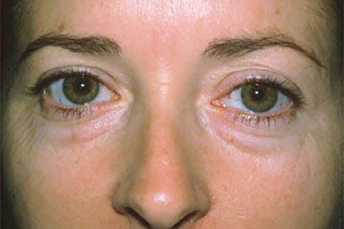 Eyelid Surgery Before & After Image