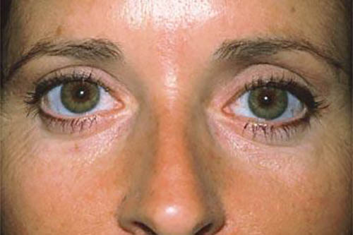 Eyelid Surgery Before & After Image