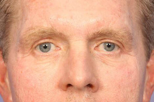 Eyelid Surgery Before & After Image