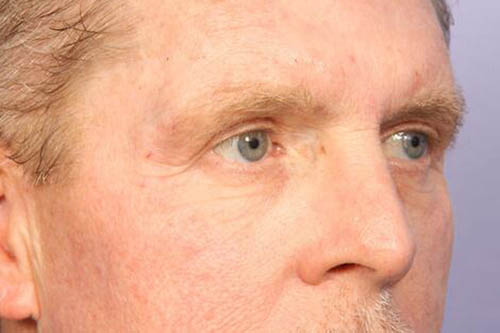 Eyelid Surgery Before & After Image