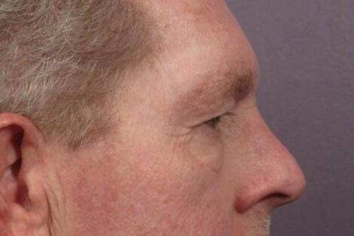 Eyelid Surgery Before & After Image