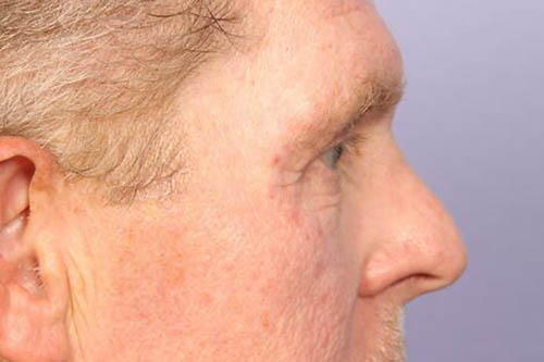 Eyelid Surgery Before & After Image