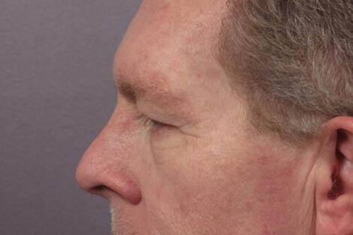 Eyelid Surgery Before & After Image