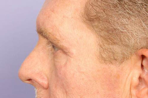 Eyelid Surgery Before & After Image