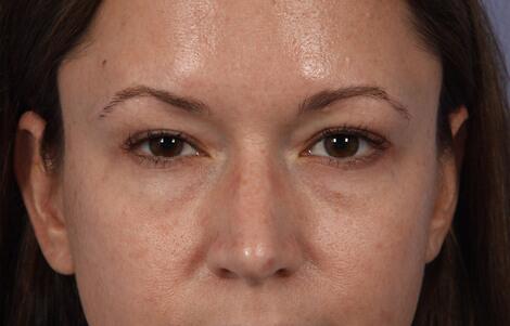 Eyelid Surgery Before & After Image