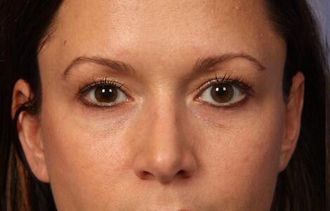 Eyelid Surgery Before & After Image