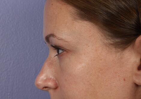 Eyelid Surgery Before & After Image