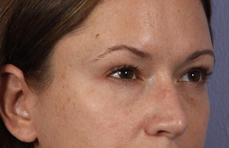 Eyelid Surgery Before & After Image