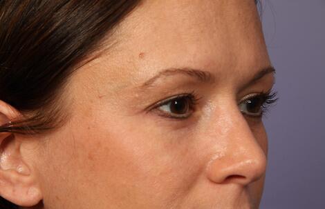 Eyelid Surgery Before & After Image