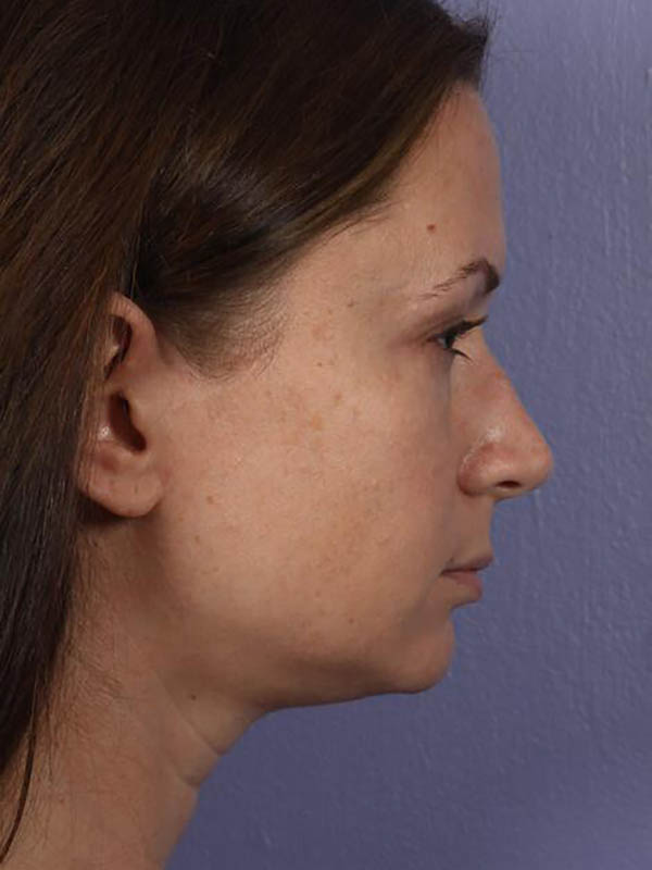 Eyelid Surgery Before & After Image