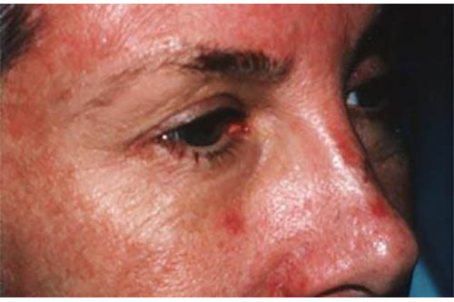 Eyelid Surgery Before & After Image