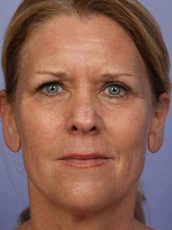 Eyelid Surgery Before & After Image