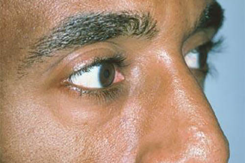 Eyelid Surgery Before & After Image