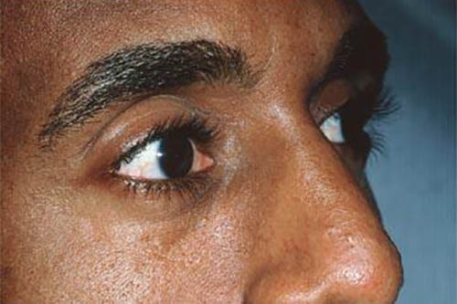 Eyelid Surgery Before & After Image