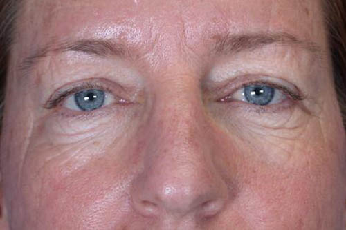 Eyelid Surgery Before & After Image