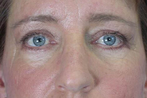 Eyelid Surgery Before & After Image