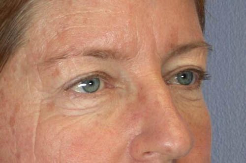 Eyelid Surgery Before & After Image