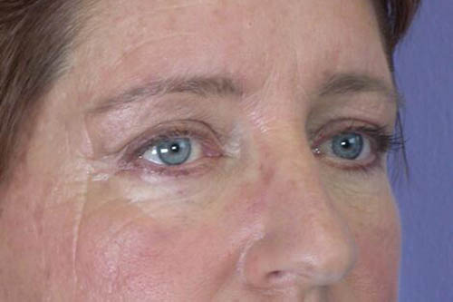 Eyelid Surgery Before & After Image