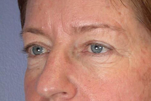 Eyelid Surgery Before & After Image