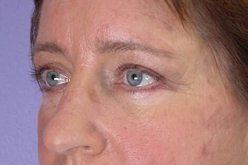 Eyelid Surgery Before & After Image