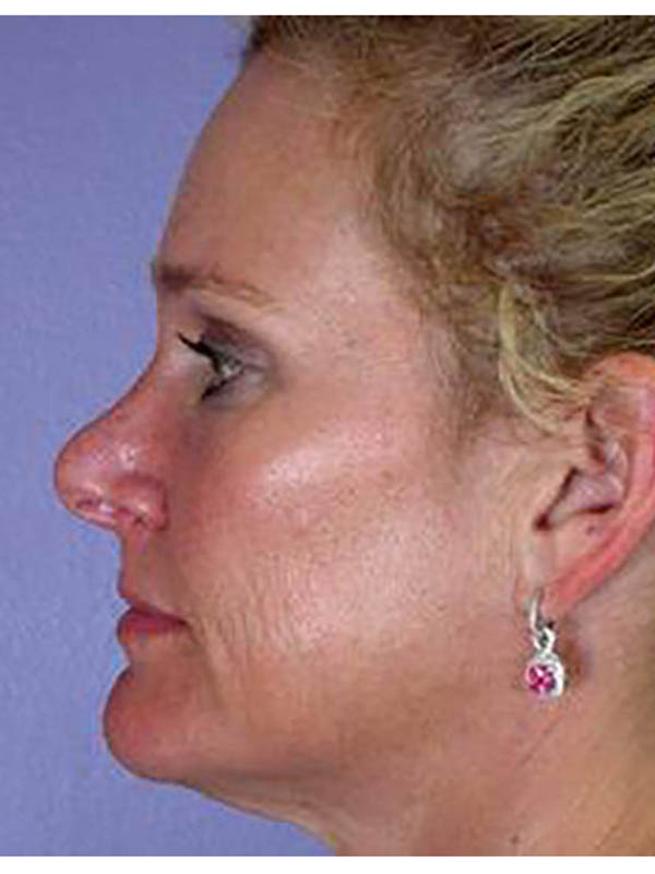 Eyelid Surgery Before & After Image