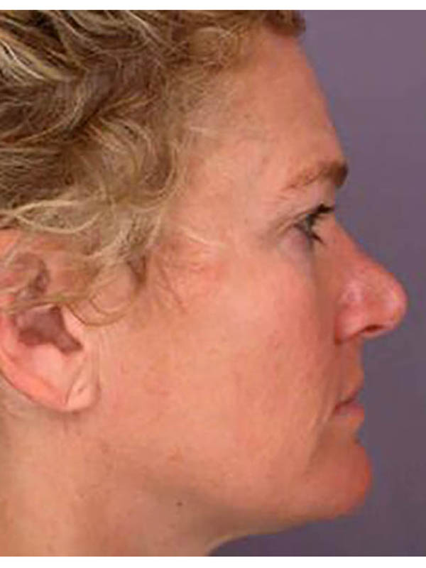 Eyelid Surgery Before & After Image