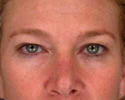 Eyelid Surgery Before & After Image