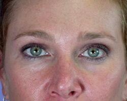 Eyelid Surgery Before & After Image