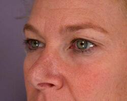 Eyelid Surgery Before & After Image