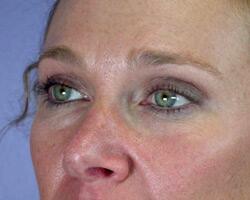 Eyelid Surgery Before & After Image