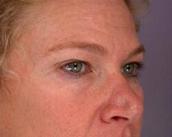 Eyelid Surgery Before & After Image