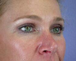 Eyelid Surgery Before & After Image