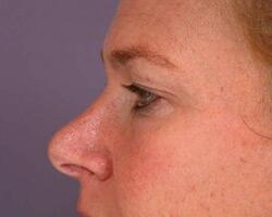 Eyelid Surgery Before & After Image