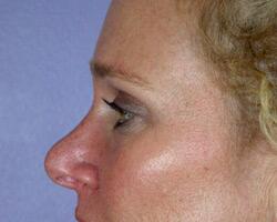 Eyelid Surgery Before & After Image