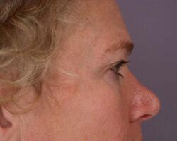 Eyelid Surgery Before & After Image