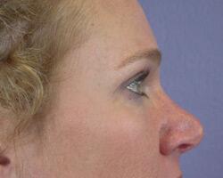 Eyelid Surgery Before & After Image