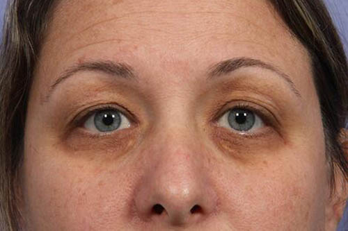 Eyelid Surgery Before & After Image