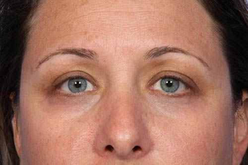 Eyelid Surgery Before & After Image