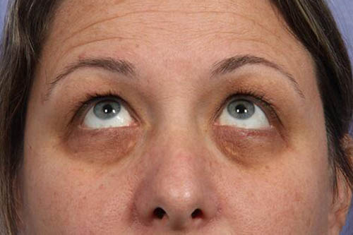 Eyelid Surgery Before & After Image