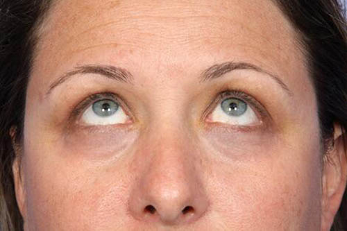 Eyelid Surgery Before & After Image