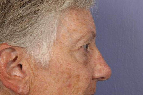 Eyelid Surgery Before & After Image