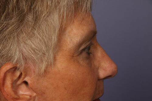 Eyelid Surgery Before & After Image