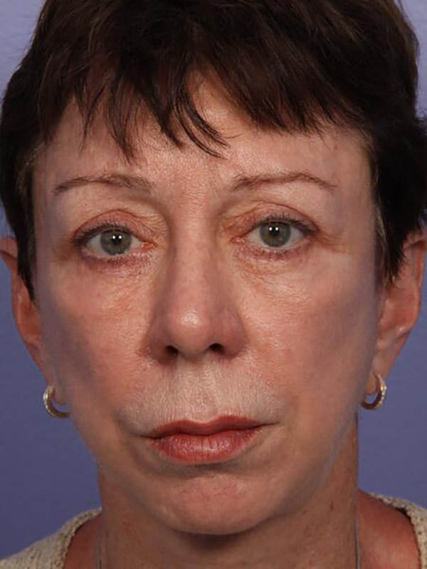 Eyelid Surgery Before & After Image