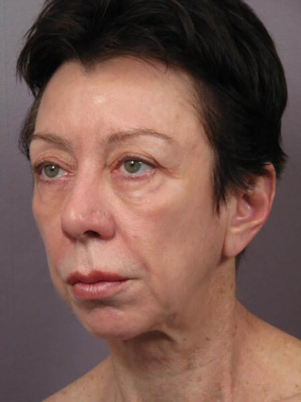 Eyelid Surgery Before & After Image